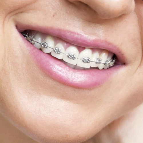 Conventional Braces at Family Smile Dental Center in Hialeah, FL, 33018